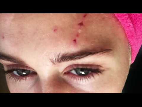 VIDEO : Miley Cyrus Gets Nasty Scratch Wounds From a Cat