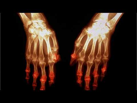 VIDEO : Joint Pain & Arthritis Could Be Side Effect Of High-Fat Diet
