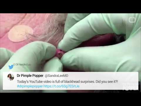 VIDEO : Dr. Pimple Popper Is Casting - (WARNING GRAPHIC)