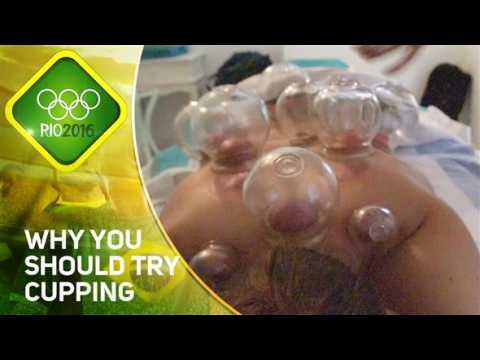 Rio 2016: Not just for Phelps! 5 reasons to try cupping