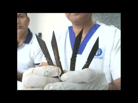 Indian doctors remove 40 knives from man's stomach