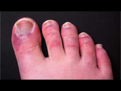 COVID warning: Jab could cause discolouration of toes and fingers