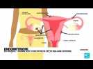 L'endométriose : une maladie méconnue qui touche 10 % des femmes