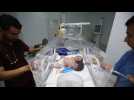 A woman gives birth in Sanaa to two girls united in the same body