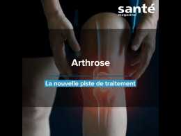 Arthrose : la nouvelle piste