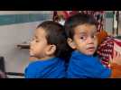 Bangladesh surgeons to separate conjoined twin girls