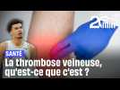 La thrombose veineuse, qu'est-ce que c'est ?