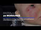 Choc à Vence : un enfant marqué par des morsures choquantes dans une crèche