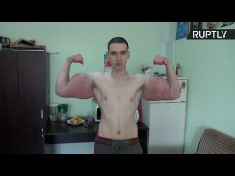 No Pain, No Gain? 21yo Grows Enormous Biceps After Drug Injections