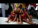 Bangladeshi twins born joined at skull to undergo surgery - Label : AFPTV - First images - Category : News
