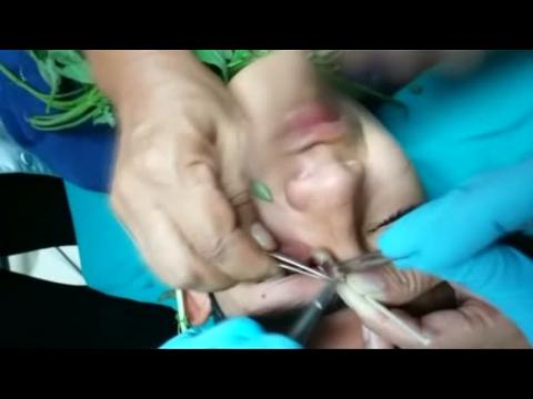 Doctors in Peru use basil to lure worm out of boy's eye