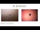 Skin Cancer: The ABCDE's of Moles and Melanomas
