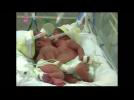 Conjoined twins in Peru to be separated