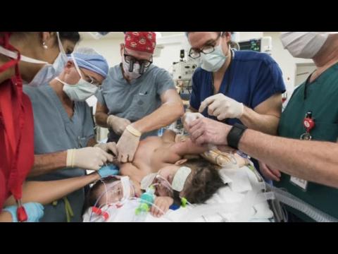Conjoined twins 'Hope and Faith' surgically separated