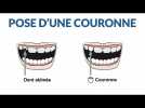 Comment le dentiste pose-il une couronne ?