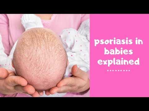 What is psoriasis and how does it affect babies? Childs Farm dermatologist reveals all #ad