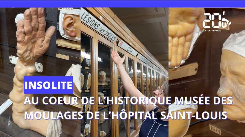 A Paris, au coeur de l'insolite musée des moulages de l'hôpital Saint-Louis