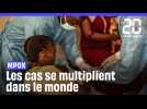 Mpox : Vers une multiplication des cas dans le monde ?