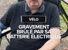 Il a été brûlé par l'explosion de la batterie électrique de son vélo