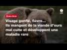 VIDÉO. Visage gonflé, fièvre... Ils mangent de la viande d'ours mal cuite et développent une maladie rare