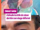 Thibault Garcia s'affiche le visage défiguré, la cause amuse les internautes