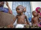 UNICEF : la malnutrition, un fléau mondial qui ne recule pas