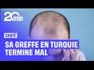 « On m'a charcuté »... Après une greffe ratée en Turquie, Clément doit tout recommencer en France