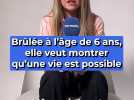 Brûlée à l'âge de 6 ans, elle veut montrer qu'une vie est possible